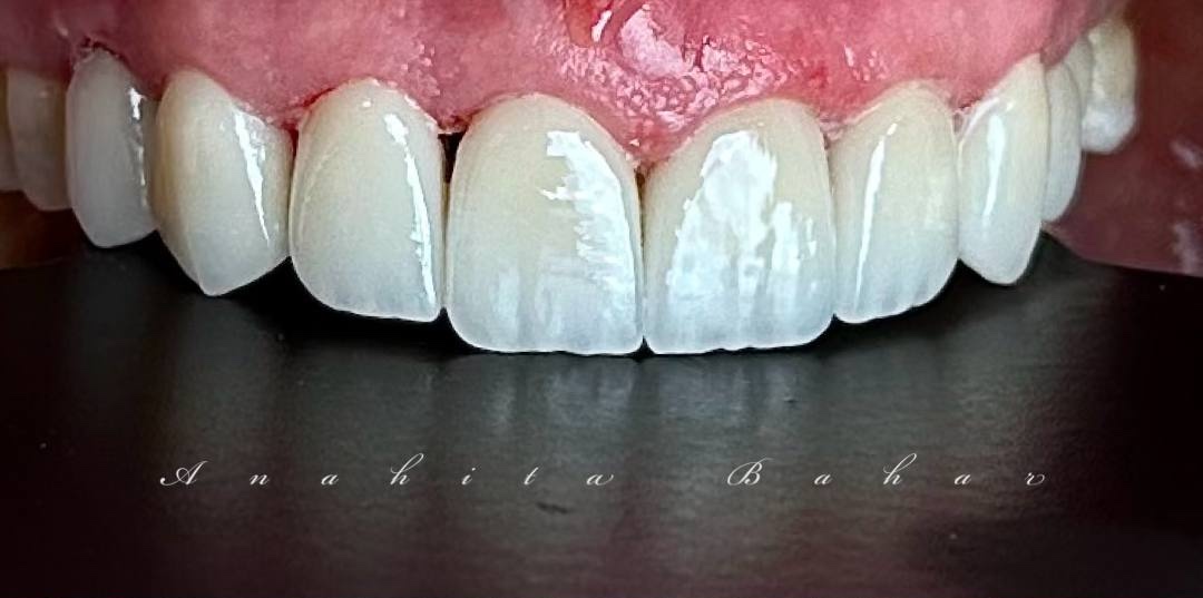 Digital Smile Design in Istanbul Dental Veneers in Istanbul Start 4,490TL | Best Quality, Best Price