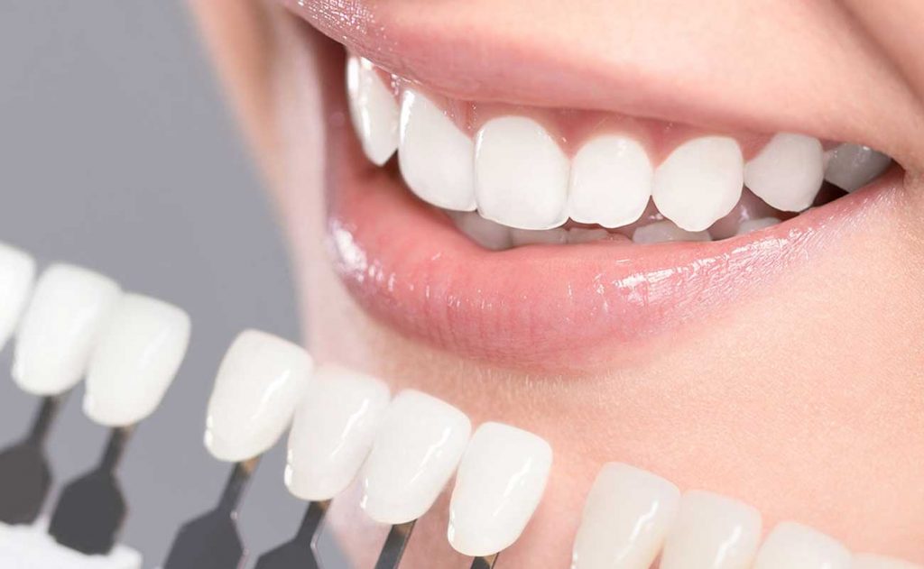 Teeth Veneers Turkey Start 4,490TL | Best Quality , Best Price