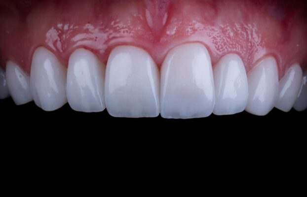 How Much is Dental Veneers in Istanbul? 30% Discount for Hollywood Smile Design