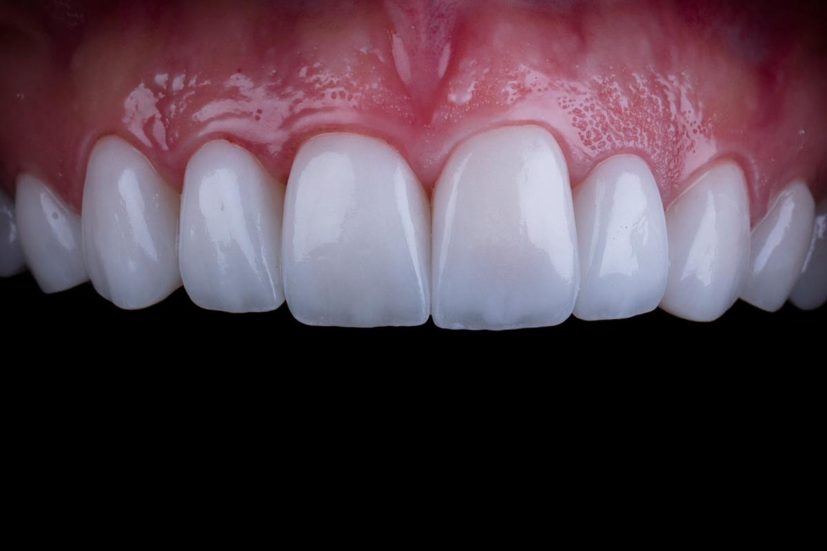 How Much is Dental Veneers in Istanbul? 30% Discount for Hollywood Smile Design